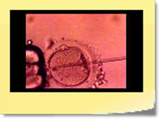 Franco Lisi - ginecologo - Tappe fecondazione assistita o fertilizzazione in vitro (fivet - icsi)